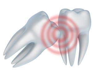 Wisdom Teeth San Jose CA, Third Molars